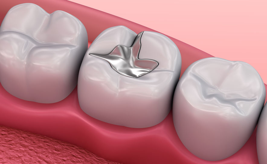 IV Therapy for Detoxification After Removing Mercury Fillings